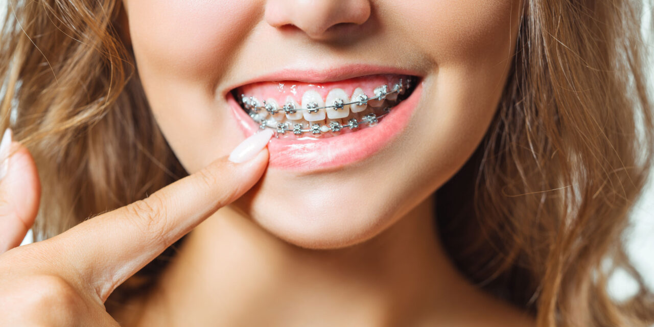 Diş Teli Nedir? Diş Teli Tedavisi Nasıl Yapılır?