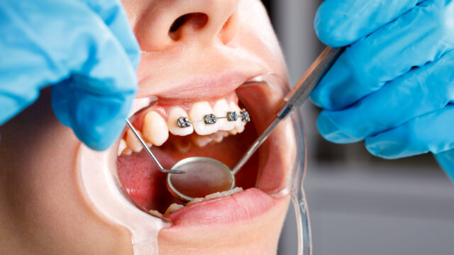 Diş teli tedavisi nasıl yapılır?