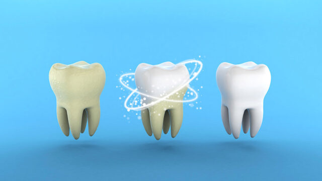teeth whitening tooth with tartar after rrrrray whitening blue background 3d render 1