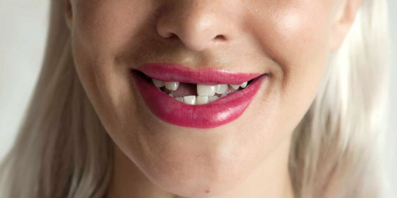 Diş Kaybı Nedenleri & Alınması Gereken Önlemler