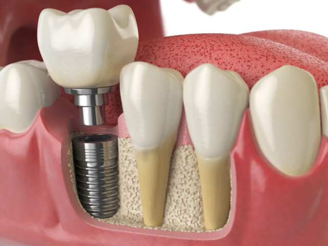 diş kaybı sonrası implant tedavisi 