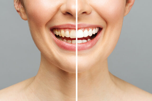woman teeth before after whitening white background dental clinic patient image symbolizes oral care dentistry stomatology