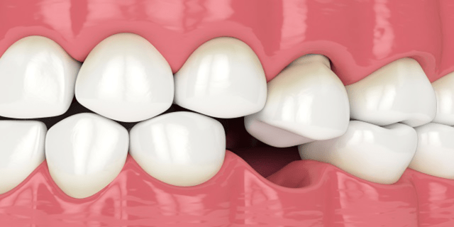 diş eksikliği 