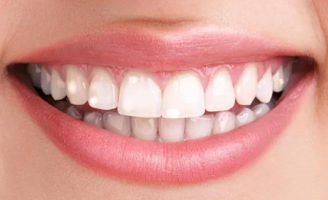 Dişlerde beyaz Lekelerin Nedenleri Nedir ? / Nasıl Önlenebilir ?