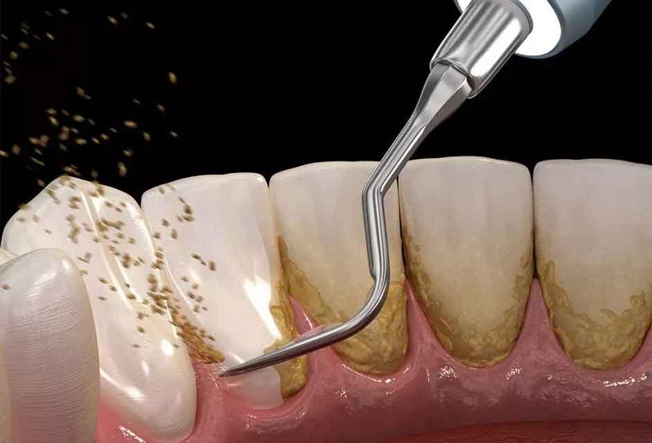 Konya Diş Taşı Temizliği Nasıl Olur ?
