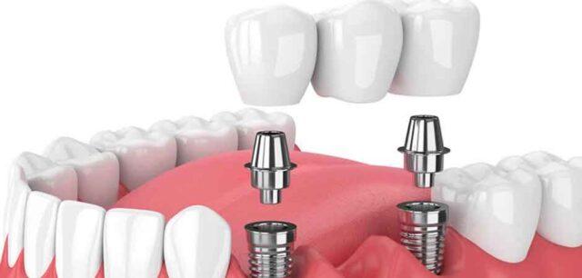 Konya implant fiyatları 2023, diş hekimi, diş kliniği, İmplant tedavisi