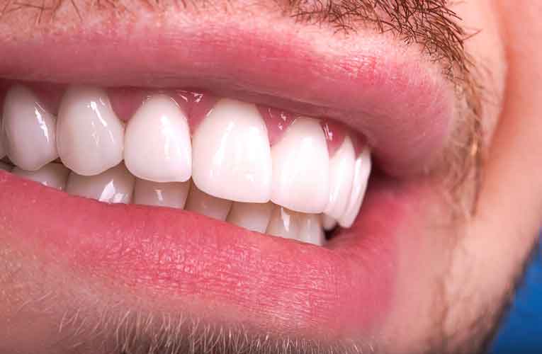 Neden Zirkonyum Diş Tedavisi?
