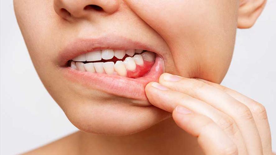 Diş Eti Çekilmesi Nedenleri, Belirtileri ve Tedavisi