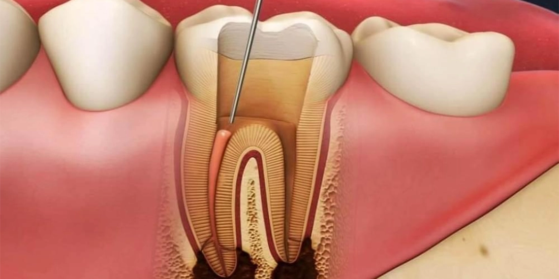 Apikal Rezeksiyon Ameliyatı: Endodonti Tedavi Seçeneği Olarak Bütün Dişlere Uygulanabilir mi?