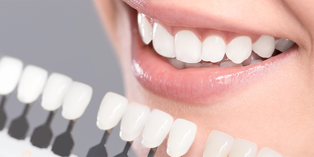 Diş Laminasyonu: Estetik ve Dayanıklı Bir Çözüm