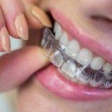 Şeffaf Diş Plağı Tedavisi: Estetik ve Konforlu Gülüş Düzeltilmesi