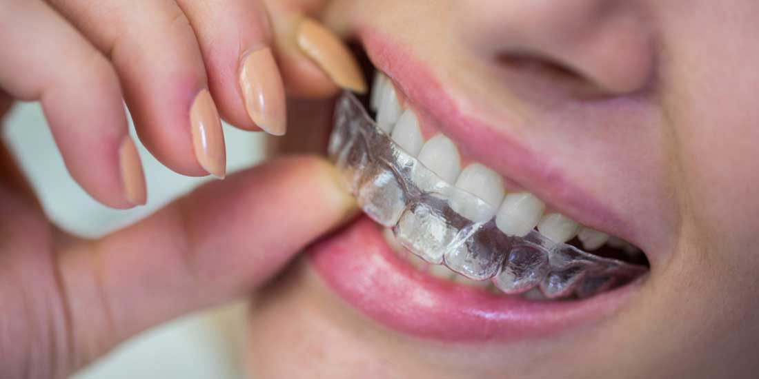 Şeffaf Diş Plağı Tedavisi: Estetik ve Konforlu Gülüş Düzeltilmesi